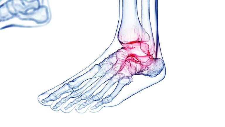 3D gerenderte medizinische Illustration von Fußschmerzen.